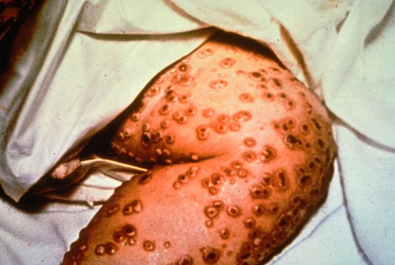 Don't destroy last smallpox stockpiles, scientists urge