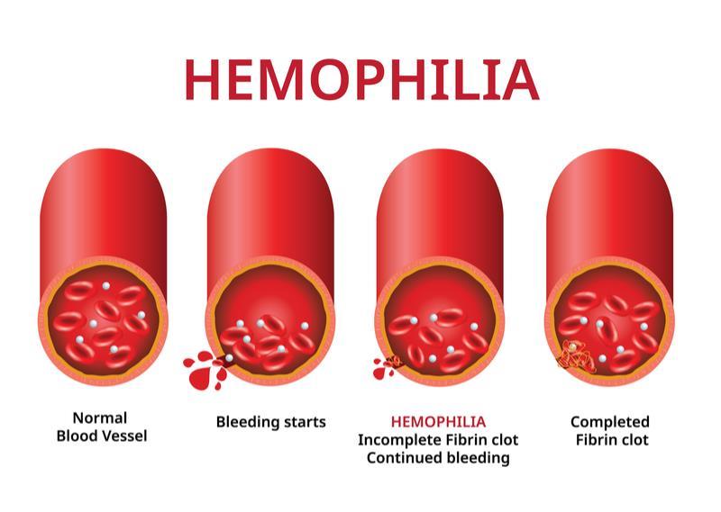 Hemophilia Gene Therapy Market Clinical Research and Analysis Report, Forecast 2020-2026