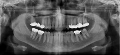 A closer look at how crystal meth attacks gums and teeth