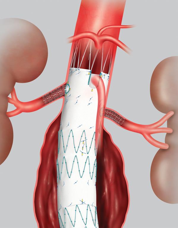 Endovascular Aneurysm Repair (EVAR) Offers Various Advantages Including Minimally Invasive Procedure and Low Recovery Time Endovascular Aneurysm Repair (EVAR) Offers Various Advantages Including Minimally Invasive Procedure and Low Recovery Time
