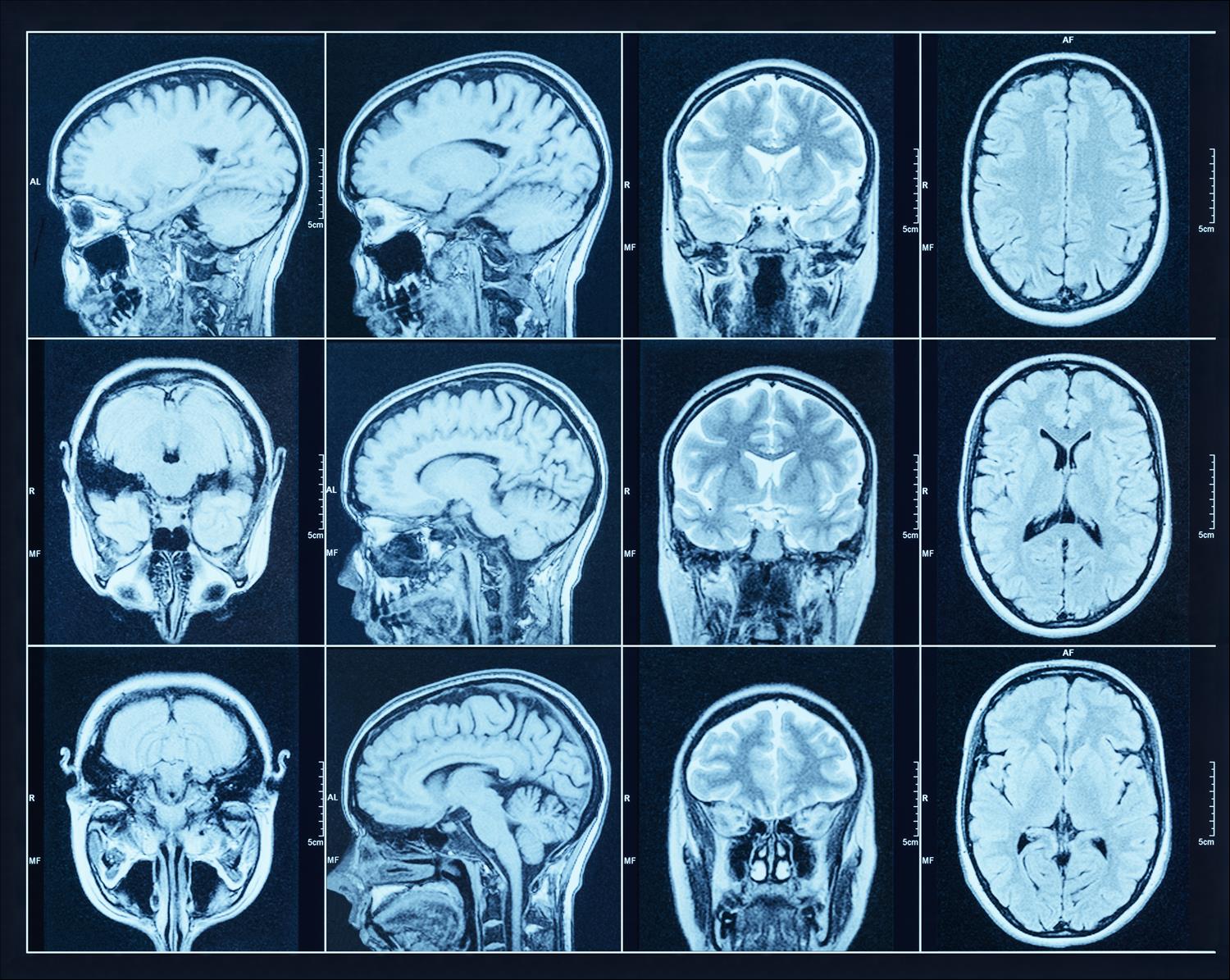 Brain charts: first comprehensive view of how the brain changes over a ...