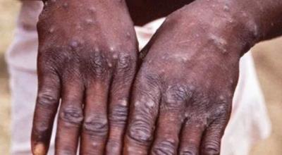  Argentina Confirms First Case Of Monkeypox 