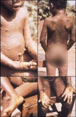 Mexico Confirms First Imported Case Of Monkeypox 