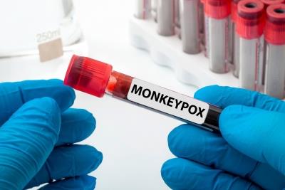 Peru Faces 'Community Transmission' Of Monkeypox: Top Health Official   Peru Faces 'Community Transmission' Of Monkeypox: Top Health Official