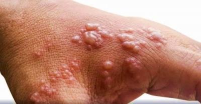 Asymptomatic Infection Concerning In Monkeypox Outbreak: Study
