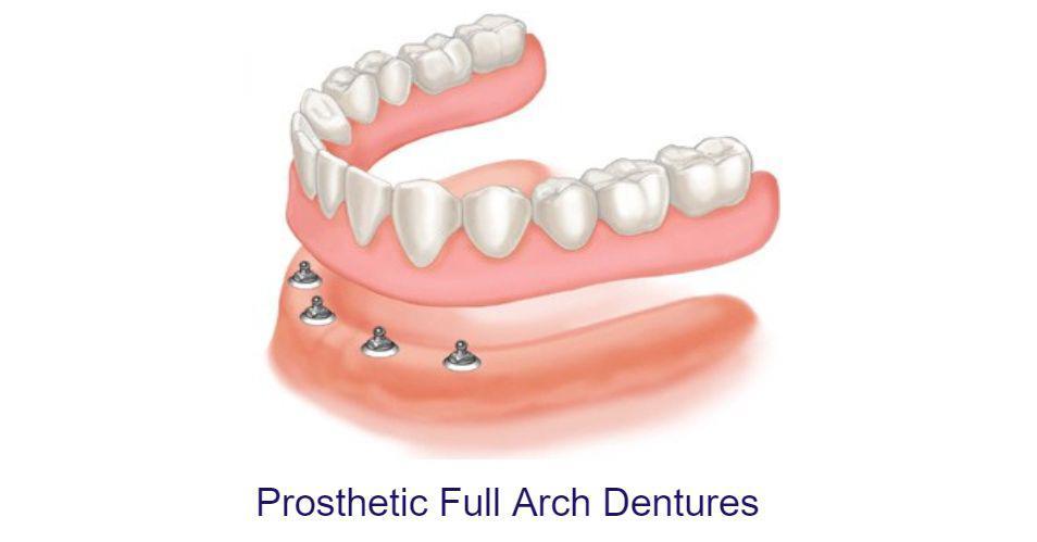 Prosthetic Full Arch Dentures Market To See Future Opportunities 2022-2030 | Nobel Biocare, DIO Corporation, Ivoclar