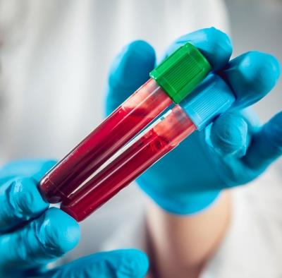  Simple Blood Test With AI Help Can Predict Who Will Get Long Covid 