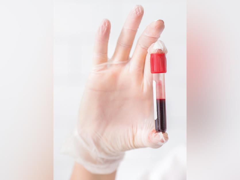 Qatar University Researchers Develop Blood Test For EarlyStage