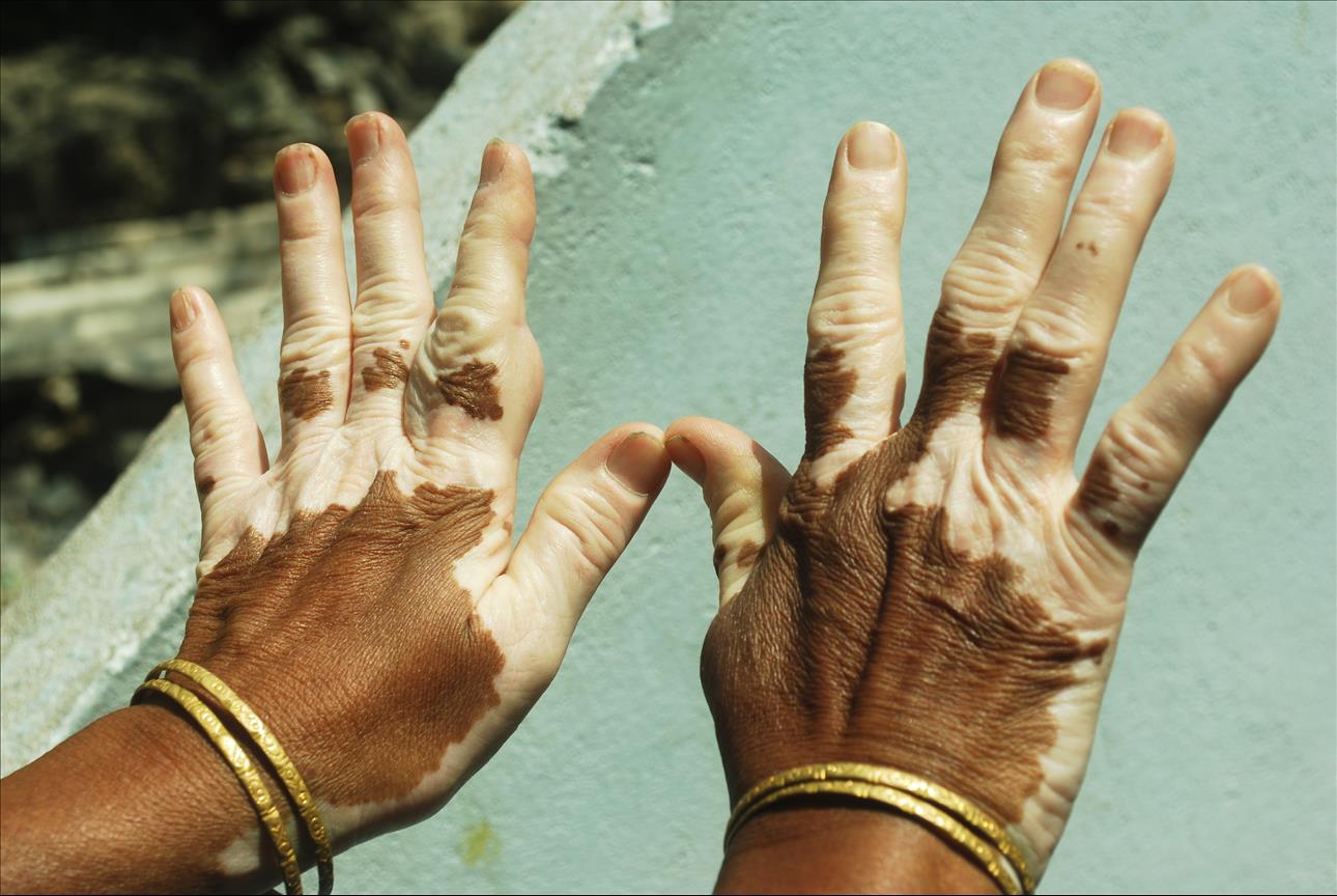 Nigerians With Vitiligo Face Stigma A Skin Doctor Calls For Better Support Menafncom 8769