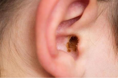 احذر اعواد القطن .. ما هي فوائد شمع الأذن والطرق الصحيحة لتنظيفه؟