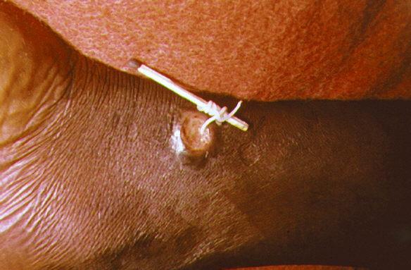 Guinea Worm: A Nasty Parasite Is Nearly Eradicated, But The Push For Zero Cases Will Require Patience