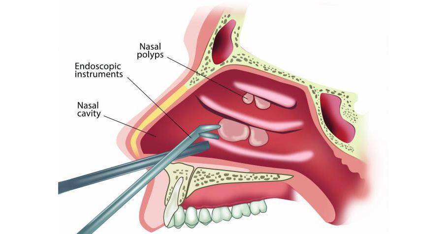 Advancements In Technology And Targeted Therapies Fuel Nasal Polyps Treatment Market Growth