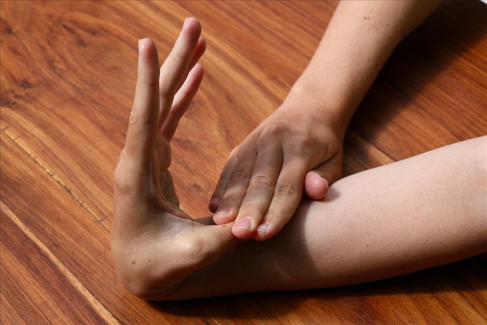 Bendy Joints, Stretchy Skin, Clumsiness. Why Hypermobile Ehlers-Danlos Syndrome Is Often Missed  And What It Has To Do With Autism