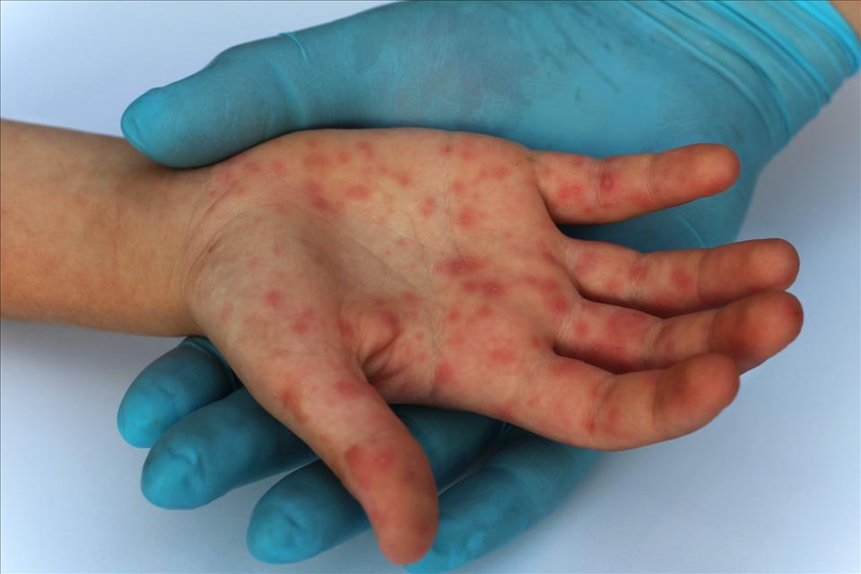 Measles Has Been Identified In NSW, Qld And SA. 5 Things To Know About The Virus