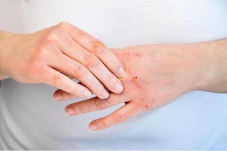 علامات تحذيرية على الجلد تدل على الإصابة بالسكري