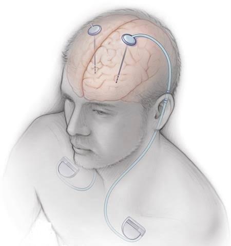 Delhi Doctors Implant Pacemaker Inside Brain To Control Parkinson's ...