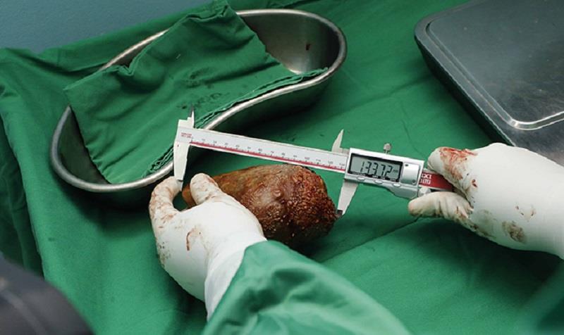 Sri Lanka Enters Guinness Records For Removing World's Largest Kidney Stone - Vimarsana News