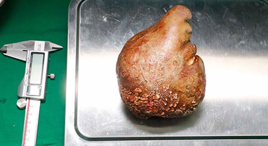 World's Largest Kidney Stone Removed And It's The Size Of A Grapefruit - Vimarsana News