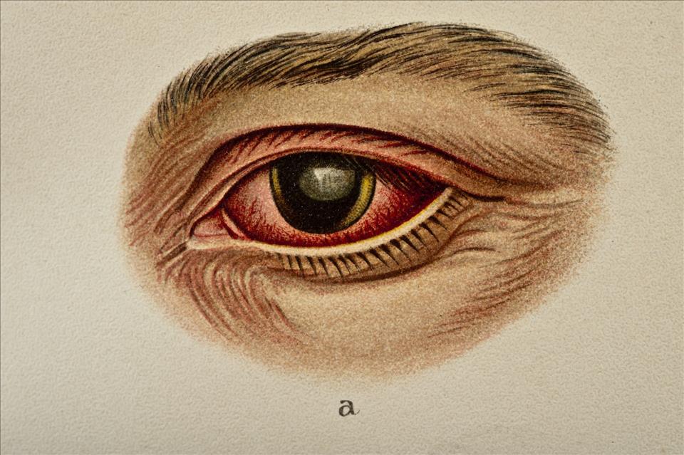 Yes, You Can Get Syphilis Of The Eye  Professor Of Ophthalmology Explains