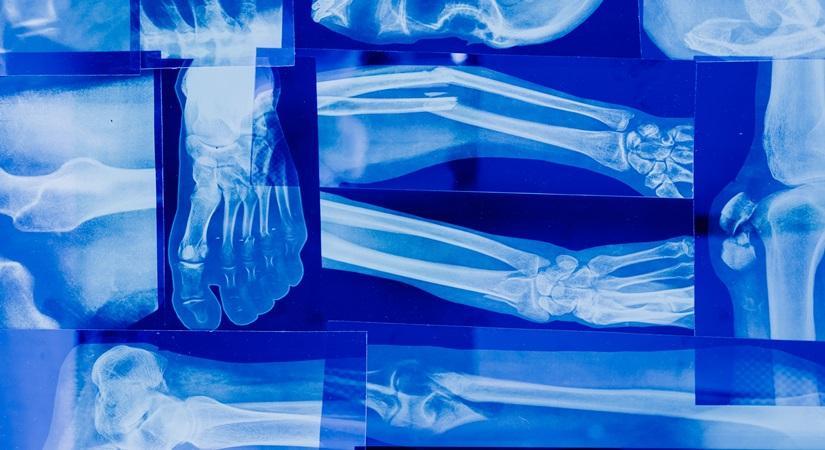 Exposure To PFAS May Affect Bone Health In Adolescents & Young Adults