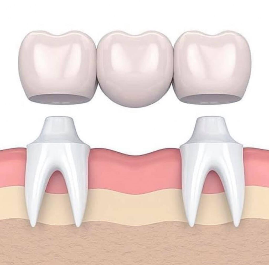 Swiftly Deciphering Dental Options Dr Corrie Crowe Guides You Through Implants Vs Bridges