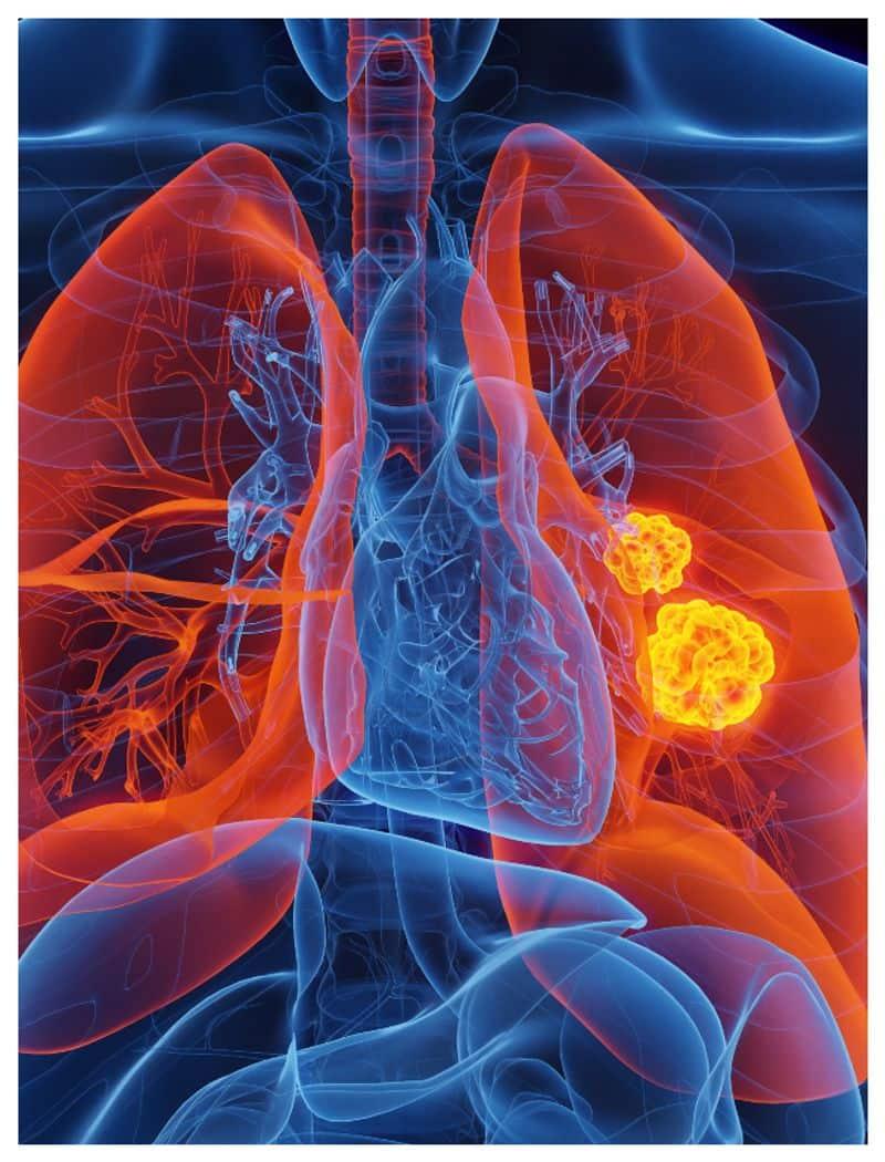 World Lung Cancer Day 2024: 7 Lesser-Known Symptoms Of Lung Cancer Image