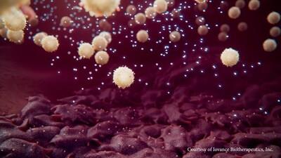 Breakthrough, Life-Saving Cancer Treatment, TIL Therapy, Offers New Hope To Patients With Metastatic Melanoma Breakthrough, Life-Saving Cancer Treatment, TIL Therapy, Offers New Hope To Patients With Metastatic Melanoma